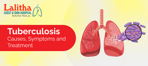 Tuberculosis – Causes, Symptoms & Treatment in Karimnagar