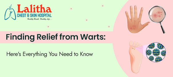 Finding Relief from Warts: Here’s Everything You Need to Know