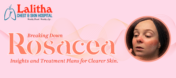 Rosacea Explained: Best Treatment Strategies for Clearer Skin