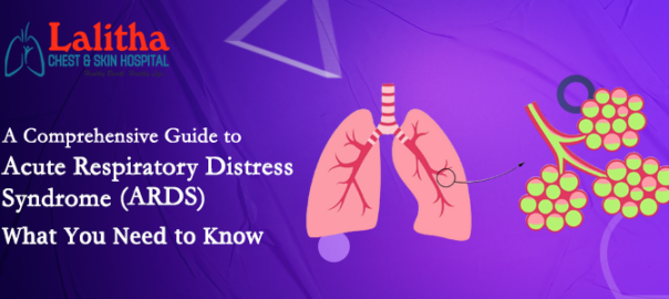 A Comprehensive Guide to Acute Respiratory Distress Syndrome (ARDS): What You Need to Know