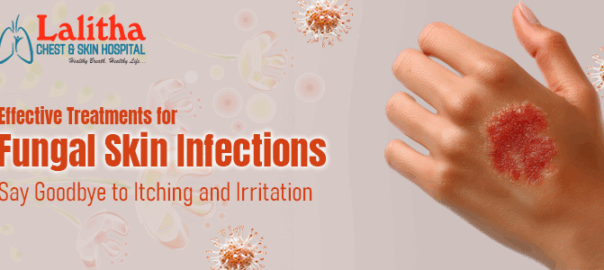 Say Goodbye to Fungal Infections | Fast Relief from Itching