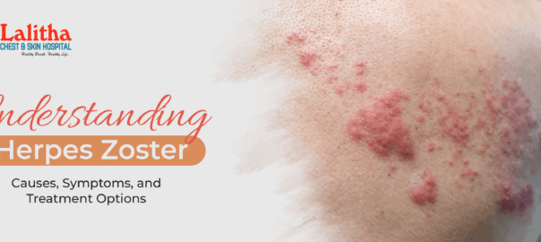Understanding Herpes Zoster: Causes, Symptoms, and Treatment Options