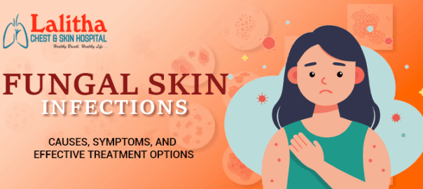 Fungal Skin Infections: Causes, Symptoms & Treatment Options