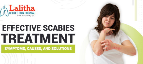 Effective Scabies Treatment | Symptoms, Causes and Solutions
